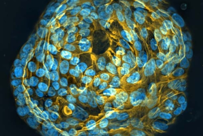 Microscope image of ovarian cancer cells