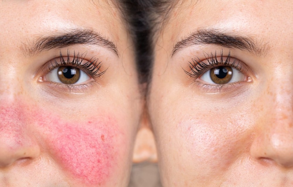 voor en na foto behandeling van rosacea