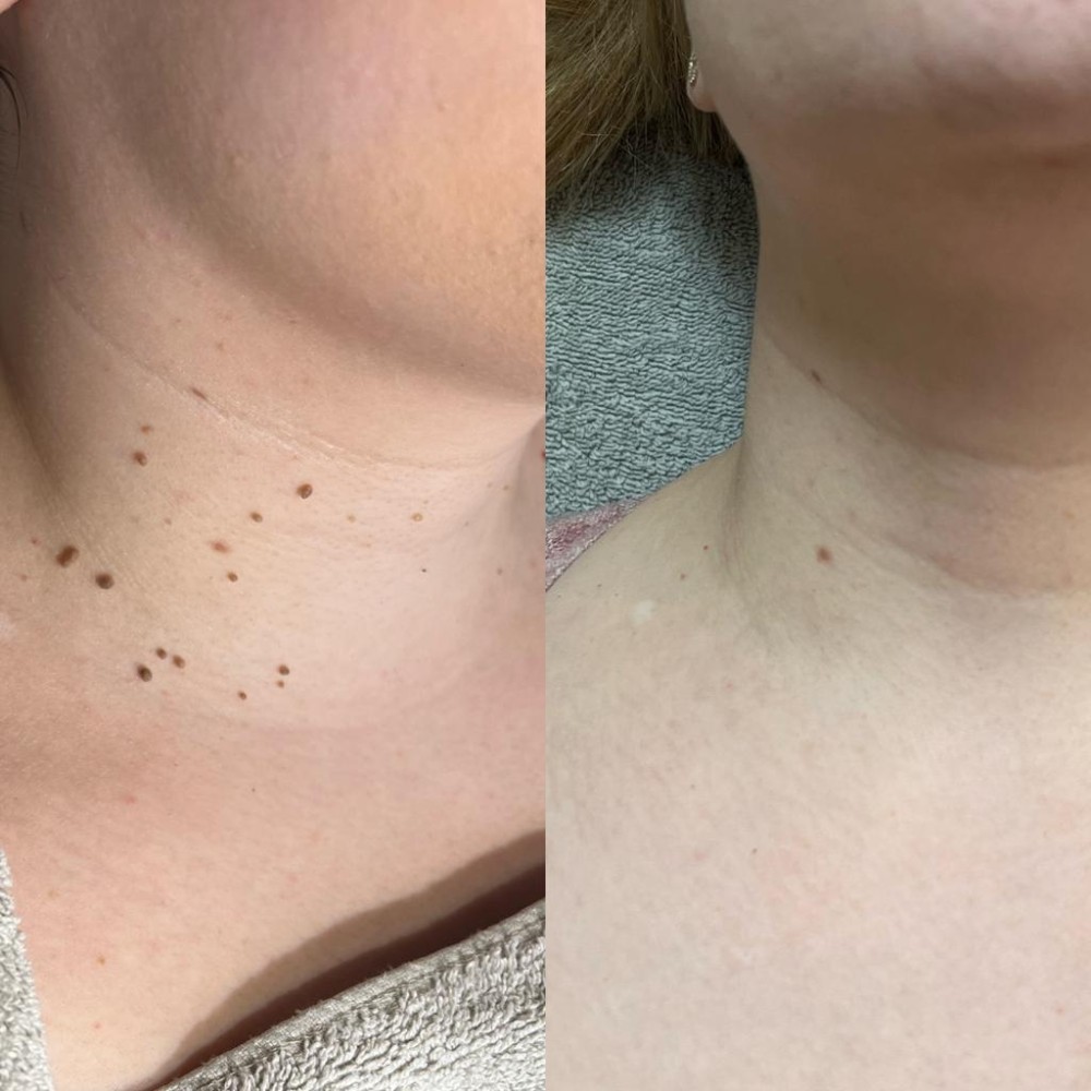 voor en na foto van behandeling van fibromen