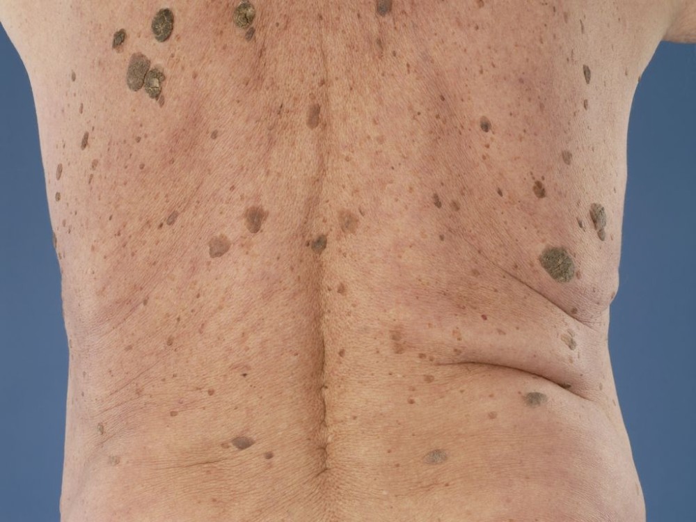 ouderdomswratten op de rug