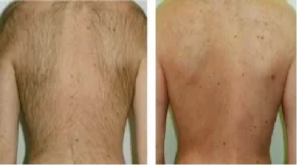 laserontharen-rug-man