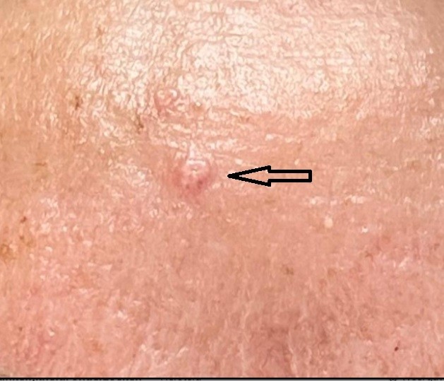 talgklierhyperplasie op het vooroofd