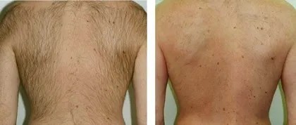 voor en na foto laserontharing rug