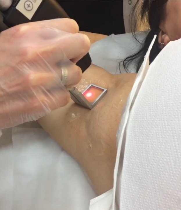 Laserbehandeling medart ontharen