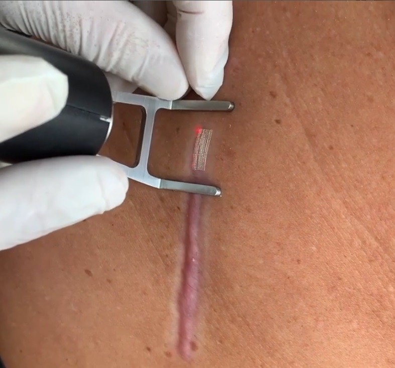 Litteken behandeling met FRX fractionele laser