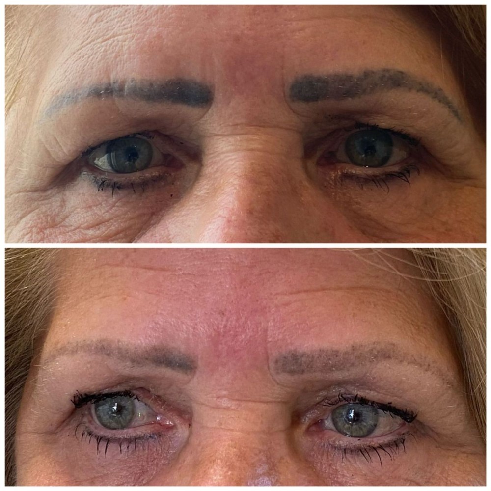 voor en na pmu laser