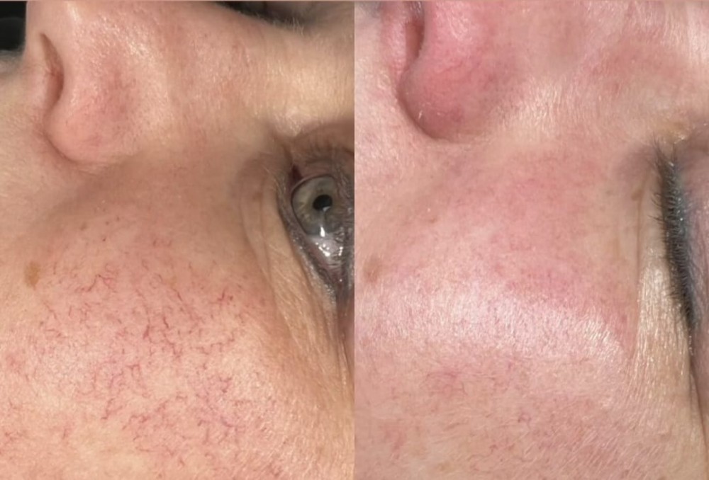 voor en na foto van behandeling met laser bij couperose