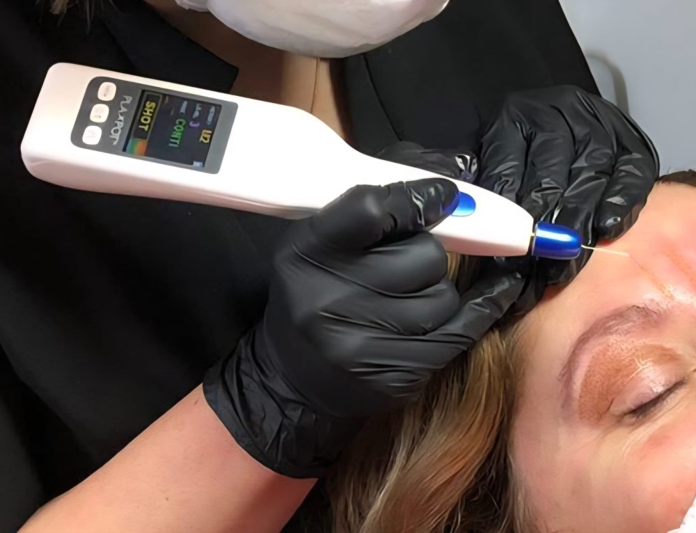 plasma huidlift behandeling