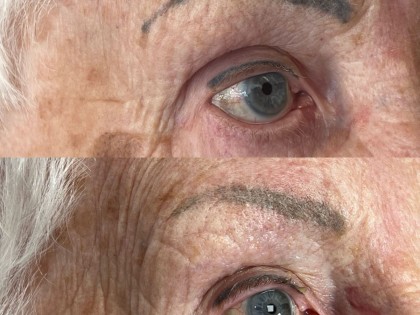 pmu verwarmen dermaplus(1)