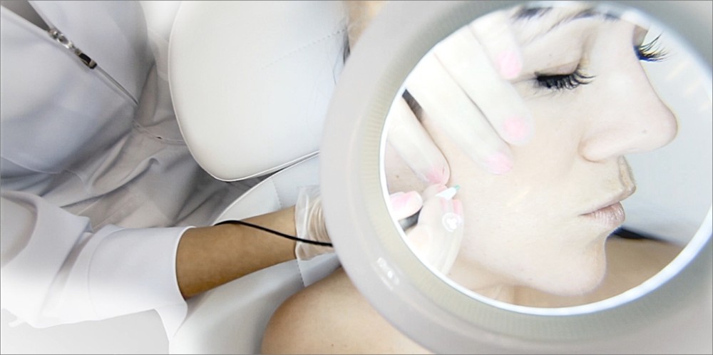 foto van elektrische epilatie