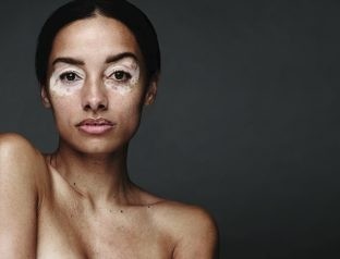 vitiligo model ph-formula