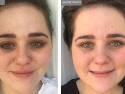 Voor-na-foto-312x238