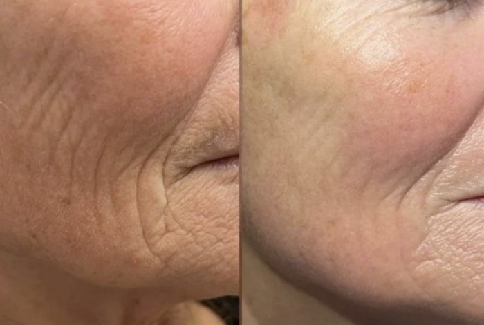 voor en na foto plasmahuidlift wangen