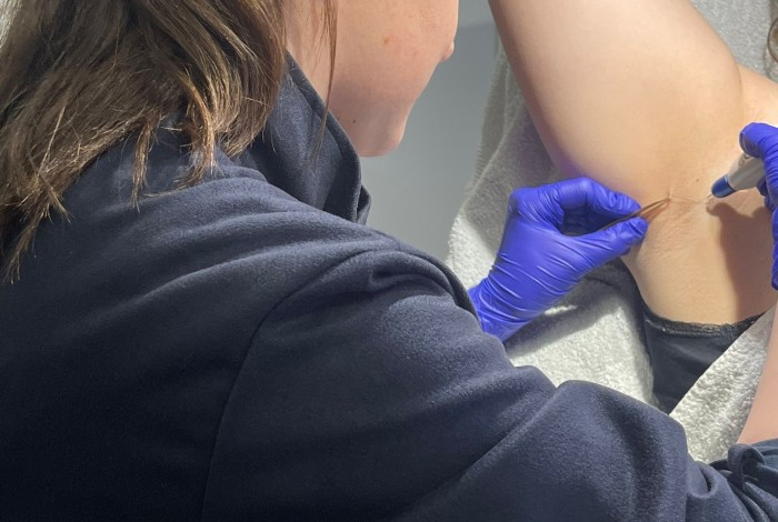 fibromen verwijderen