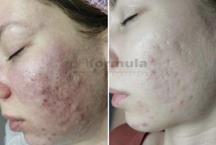 voor-en-nafoto-acne